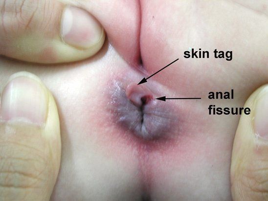 Anal fissure hentai Sperm penis pic