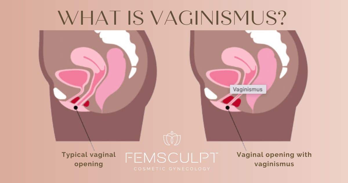 Cleft of venis Sex guide in istanbul