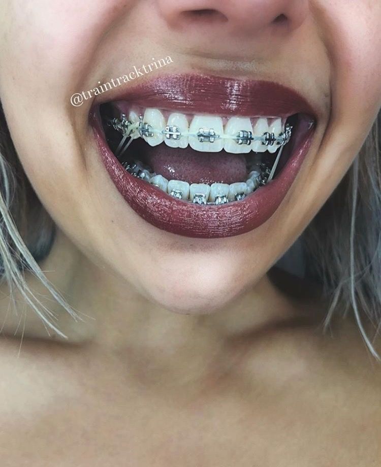 Girls with braces tumblr Sex stories with images